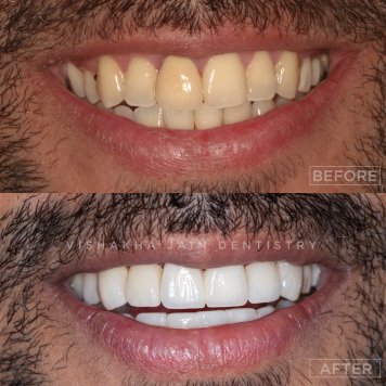 Laser Teeth Whitening & Bleaching at Top Dental Clinic in Indore