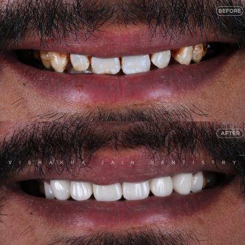 Safe & Effective Teeth Whitening Services in Indore