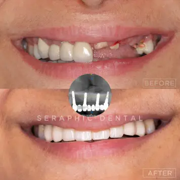 dental implants